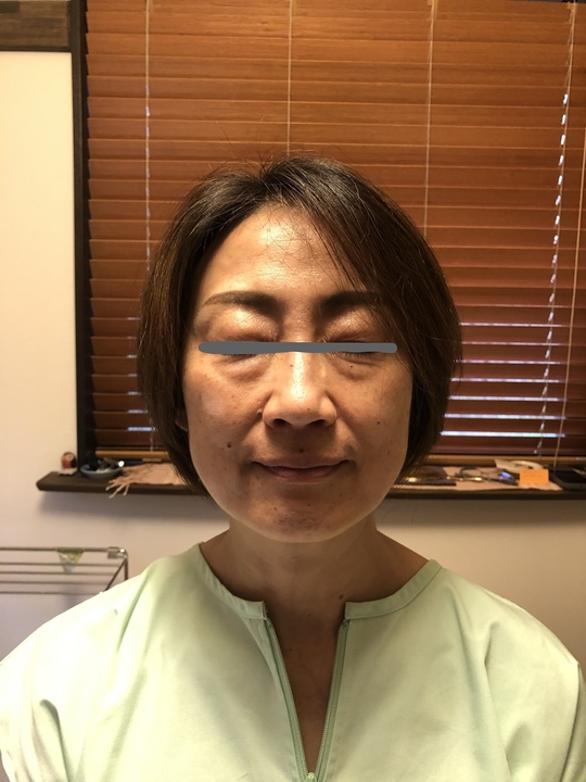 立体造顔美容鍼 - 松本市にある女性専用の鍼灸院 HARU（ハル）